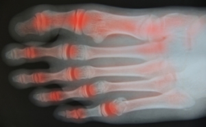 Walking May Help With Symptoms of Arthritis
