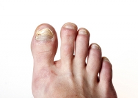 Why Fungal Nails Can Be Difficult to Treat
