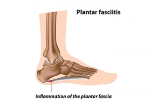 Treating Plantar Fasciitis