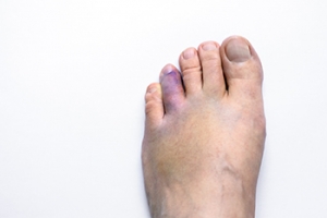 Recovery Time for a Broken Toe