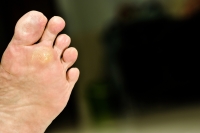 Where on the Feet Does a Plantar Wart Develop?